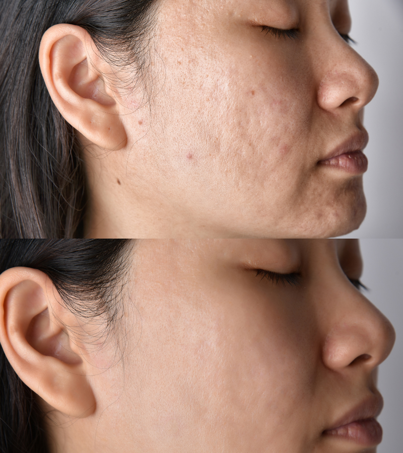 acne scar treatment