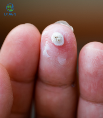 Warts on finger treatment by Dr A&N Clinic